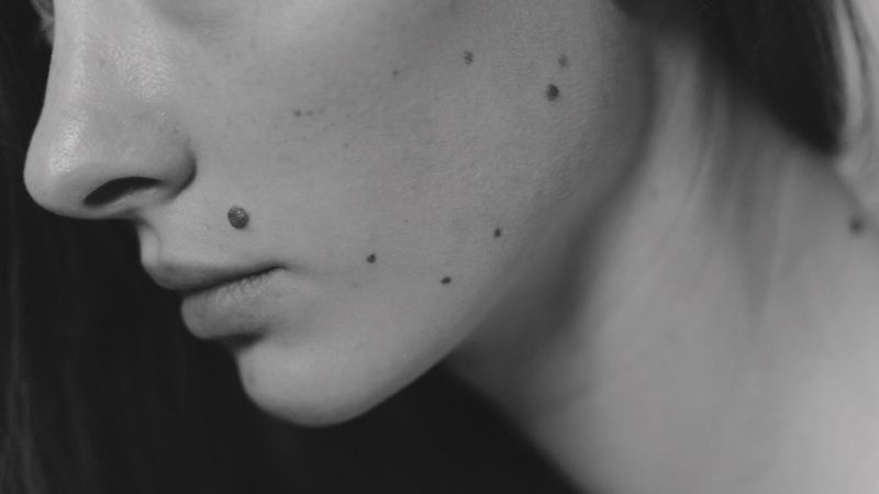 Benign Moles Removal FAQs Gosport Gosport