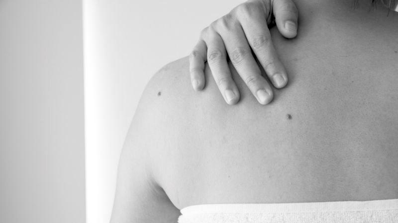Who Is Suitable for Benign Mole Removal Gosport? Gosport