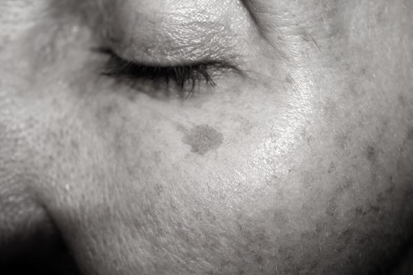Age Spots Removal in Gosport&ndash; Clear, Even-Looking Skin at Home Gosport