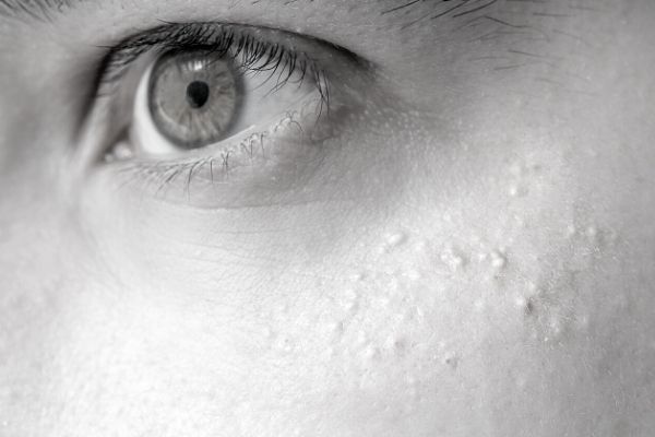 Aftercare Advice Following Milia Removal Gosport Gosport