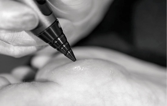Warts Aftercare Advice for Faster Healing Gosport