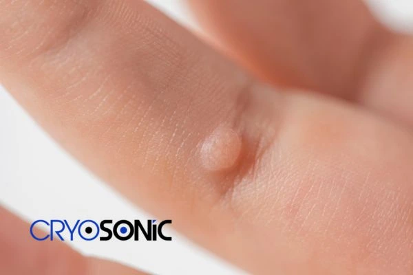 Contact Cryosonic today to learn more about us Gosport now! Gosport