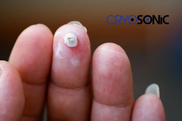 Learn more about us Gosport at Cryosonic. Book in today! Gosport