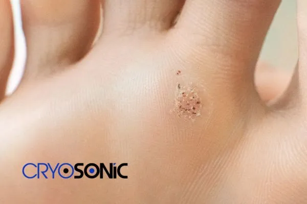 Book in your Verrucae removal treatment today Gosport Gosport