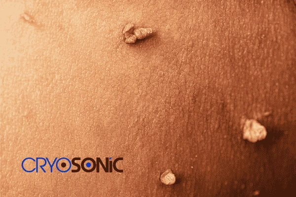 Do you want to get skin tags removal Gosport? Contact our team today! Gosport