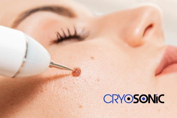 why choose us at Cryosonic for blemish removal? Find out more now Gosport