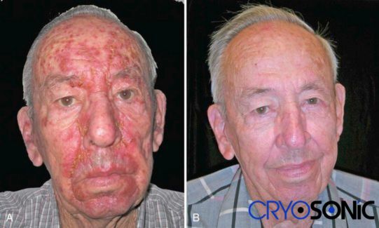 Actinic Keratosis Treatment before and after results Gosport Gosport