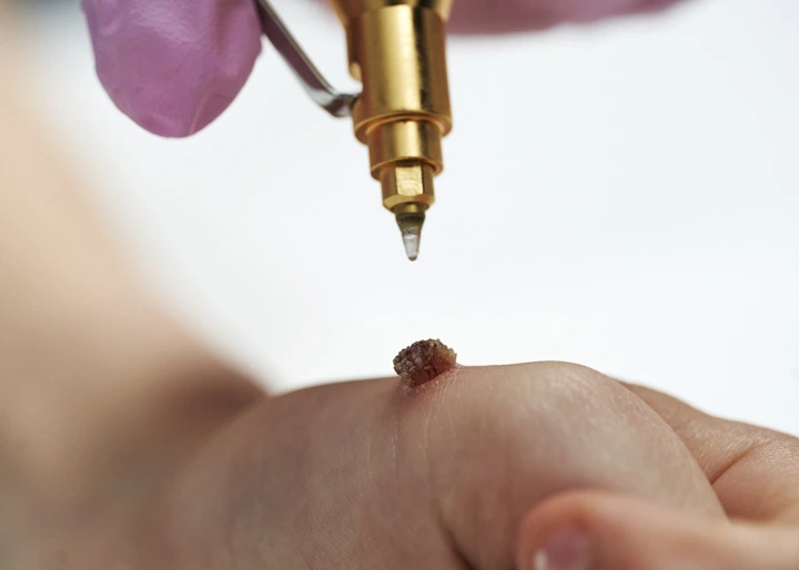 Cryopen For Children Bristol Gosport