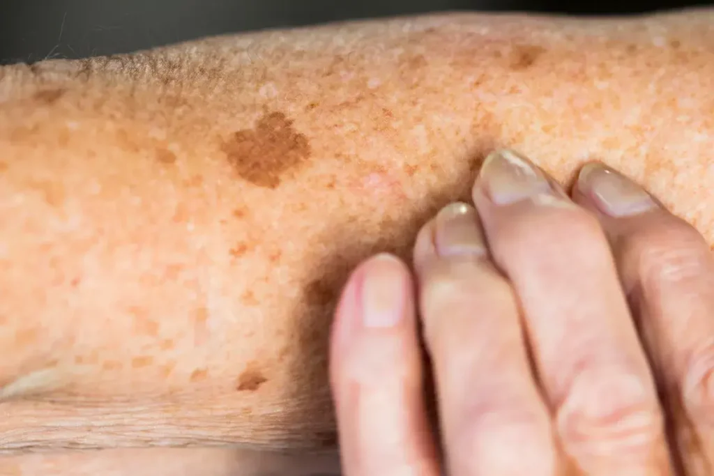 Sun Damage Aftercare and Skin Recovery Gosport