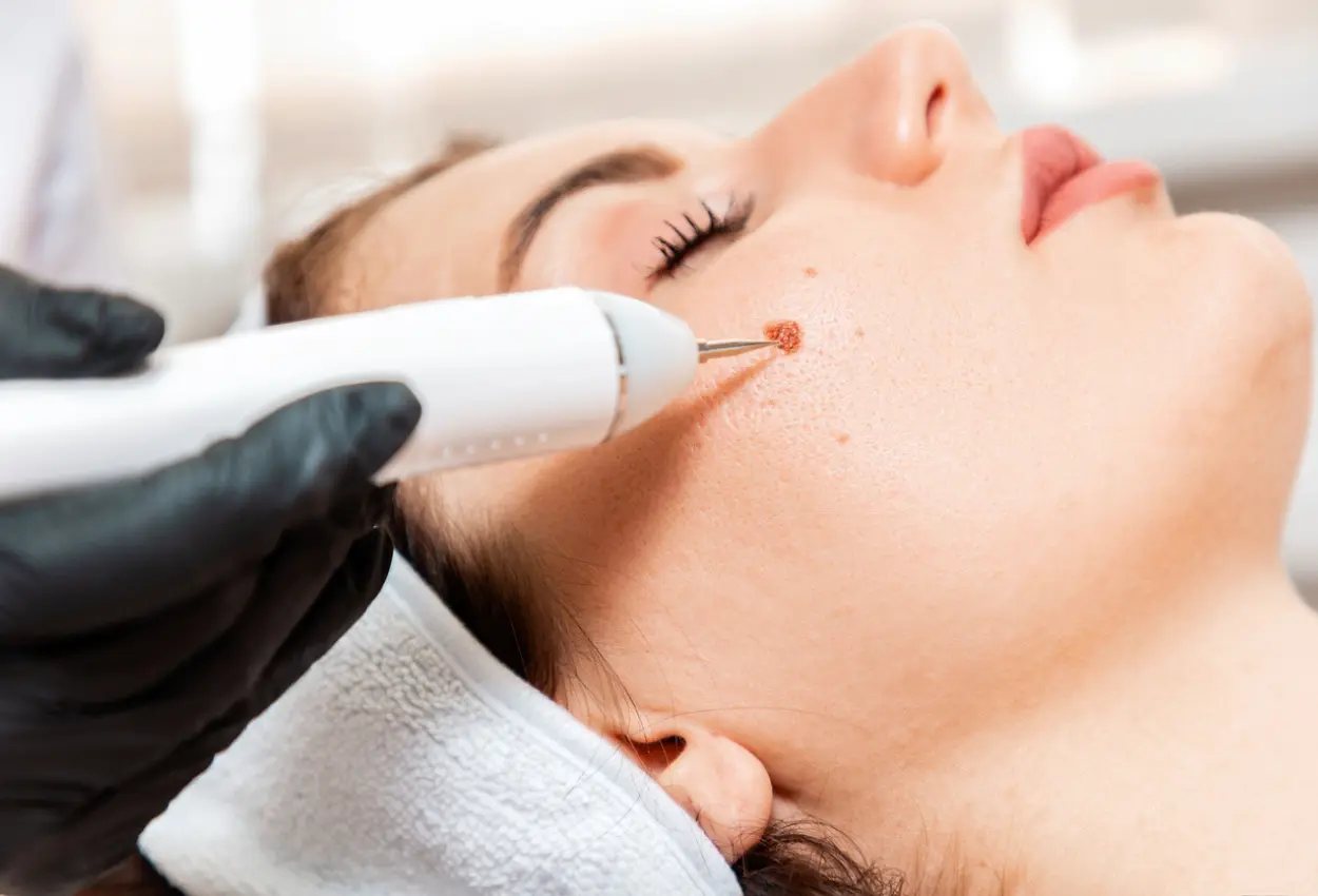 Frequently Asked Questions About Multiple Cryotherapy Treatments Gosport