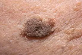 Recovery and Aftercare Advice after Seborrhoeic Keratosis Gosport