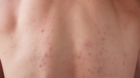 Molluscum Contagiosum Aftercare Advice for Faster Healing Gosport