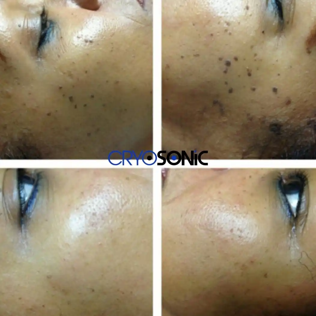 Why Skin Shows Pigmentation After Treatment Gosport