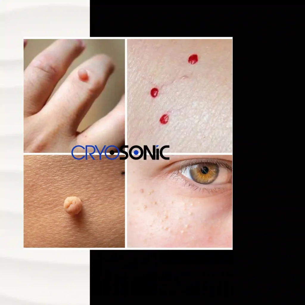 What Are the Different Types of Benign Skin Lesions in Gosport Gosport