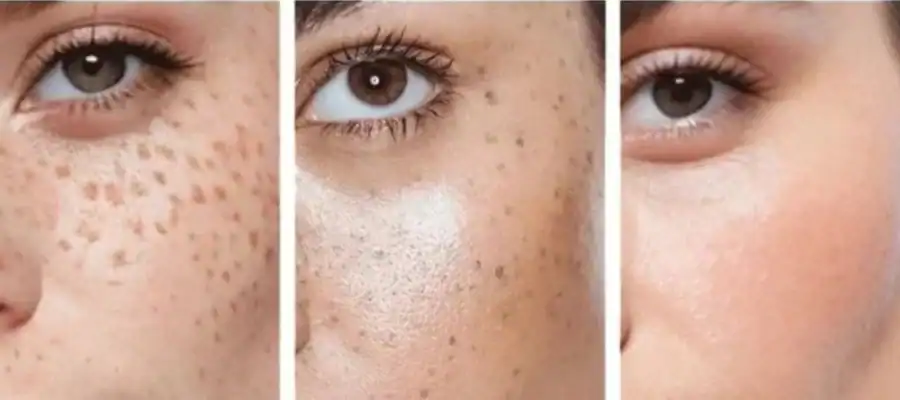 Ephelides Removal Results and Healing Timeline Gosport