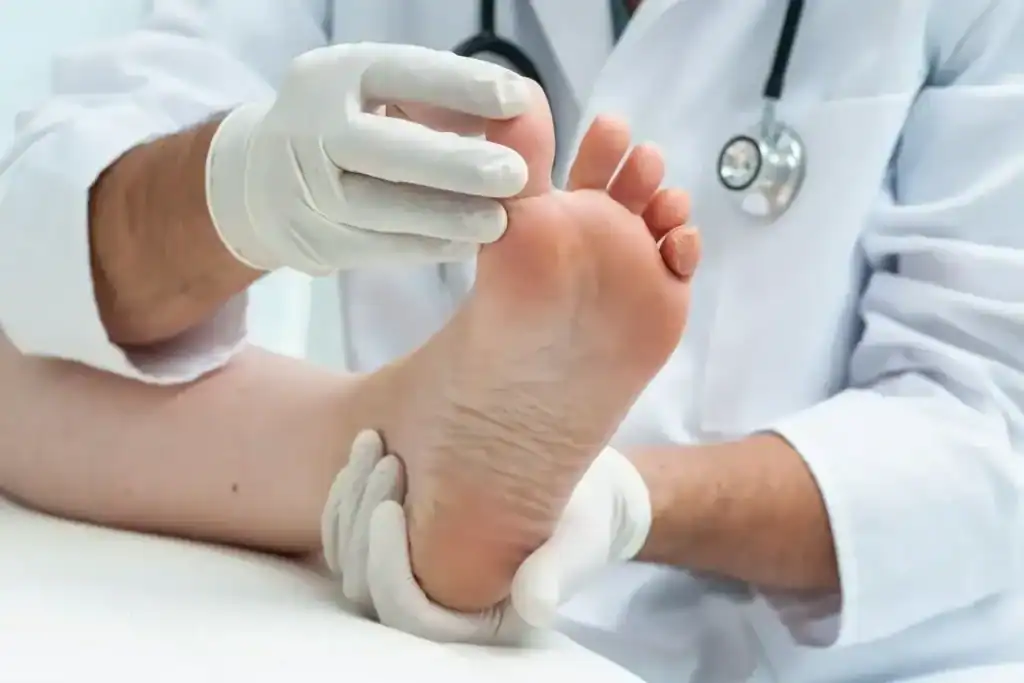 Porokeratosis Removal Treatment Gosport
