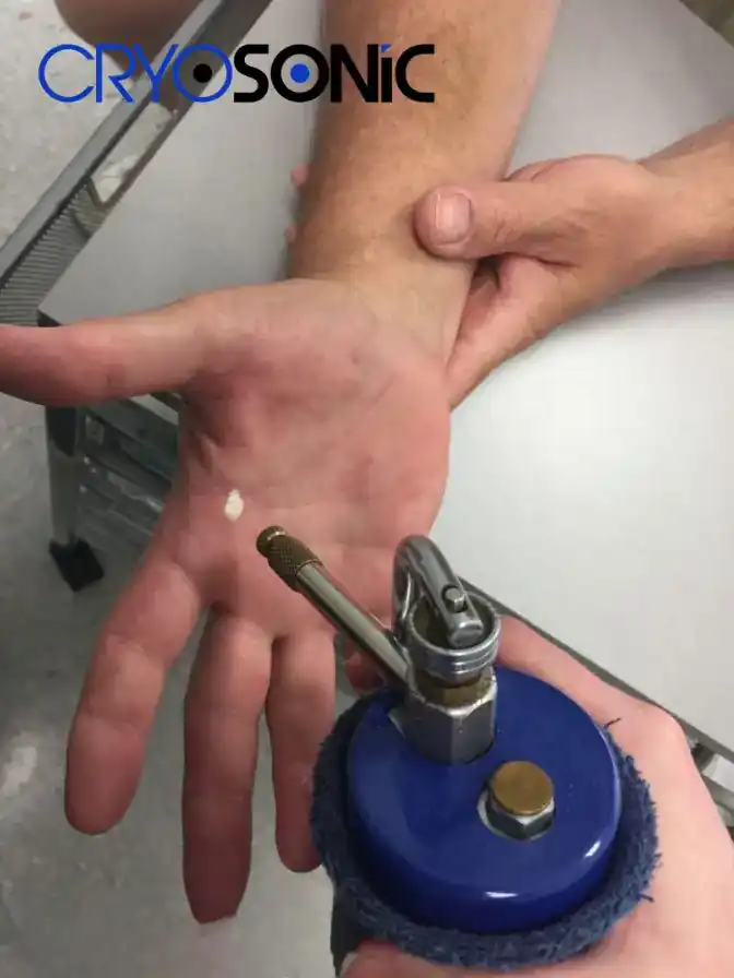 Temperature Differences: OTC vs Medical-Grade Cryotherapy Gosport